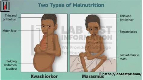 Marasmus