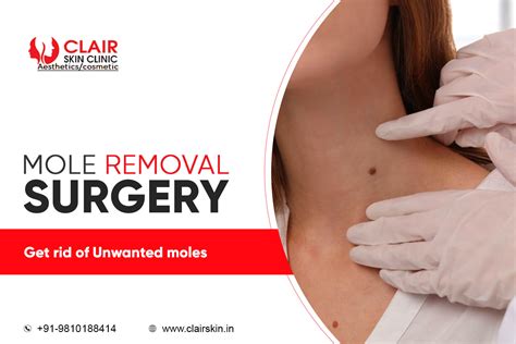 Mole Surgical Removal