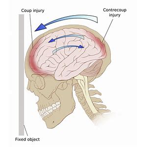 open brain injury