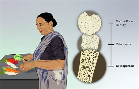 Osteoporosis Wanita