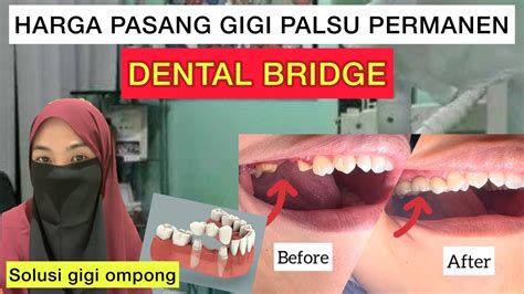 pemasangan gigi palsu BPJS