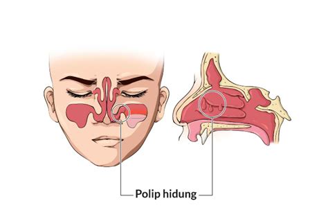polip hidung
