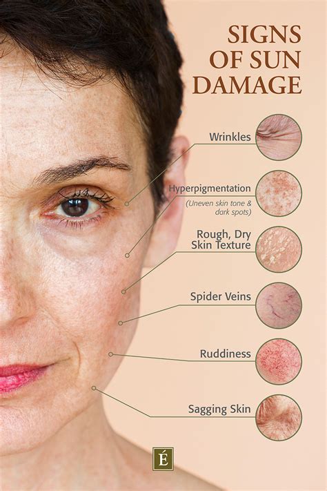 Sun Damage