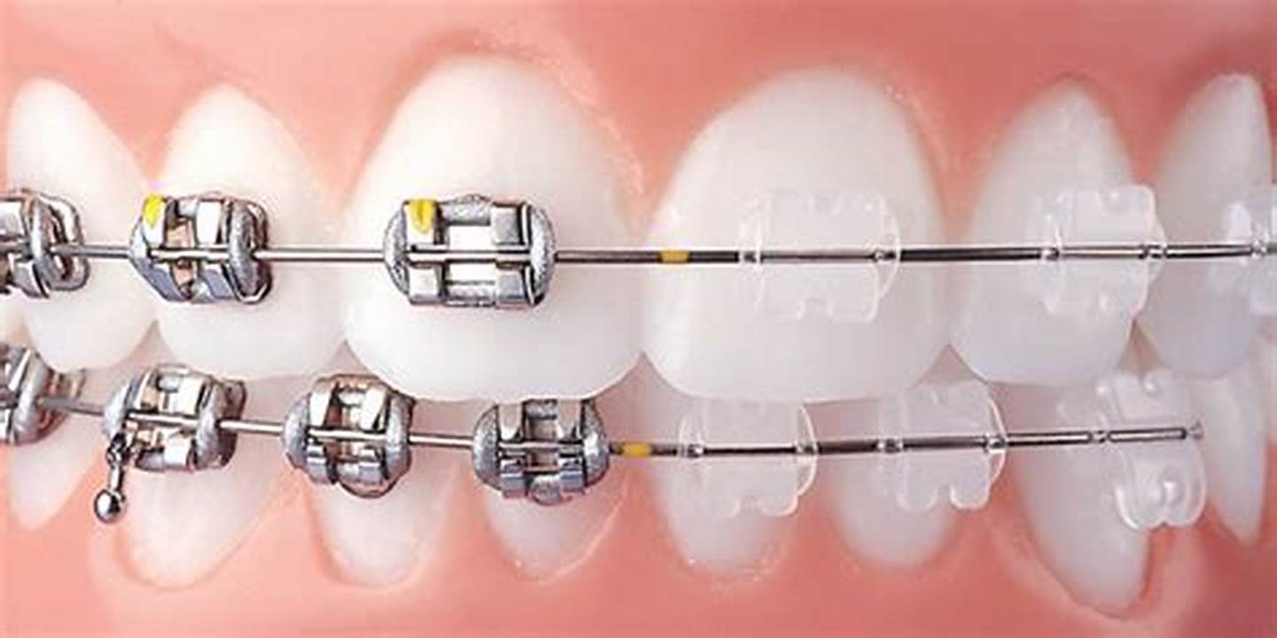 tingkat keparahan kasus ortodontik