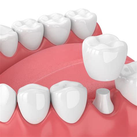 versatile and customizable dental crown