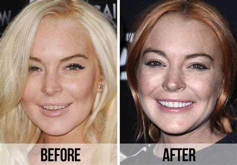 what happened to lindsay lohan's teeth